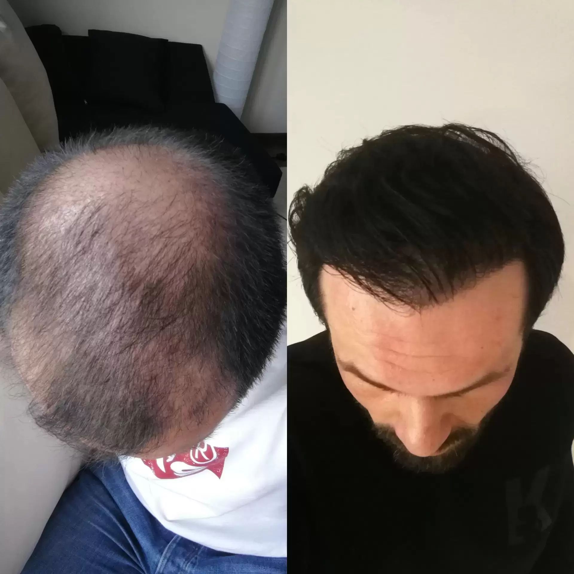 4700 Grafts Hair Transplantation Estheticoncom 4700 Grafts Hair Transplantation Estheticoncom