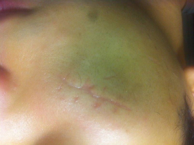 Scar Removal Cost In Germany Scar Removal Forums Estheticon Com