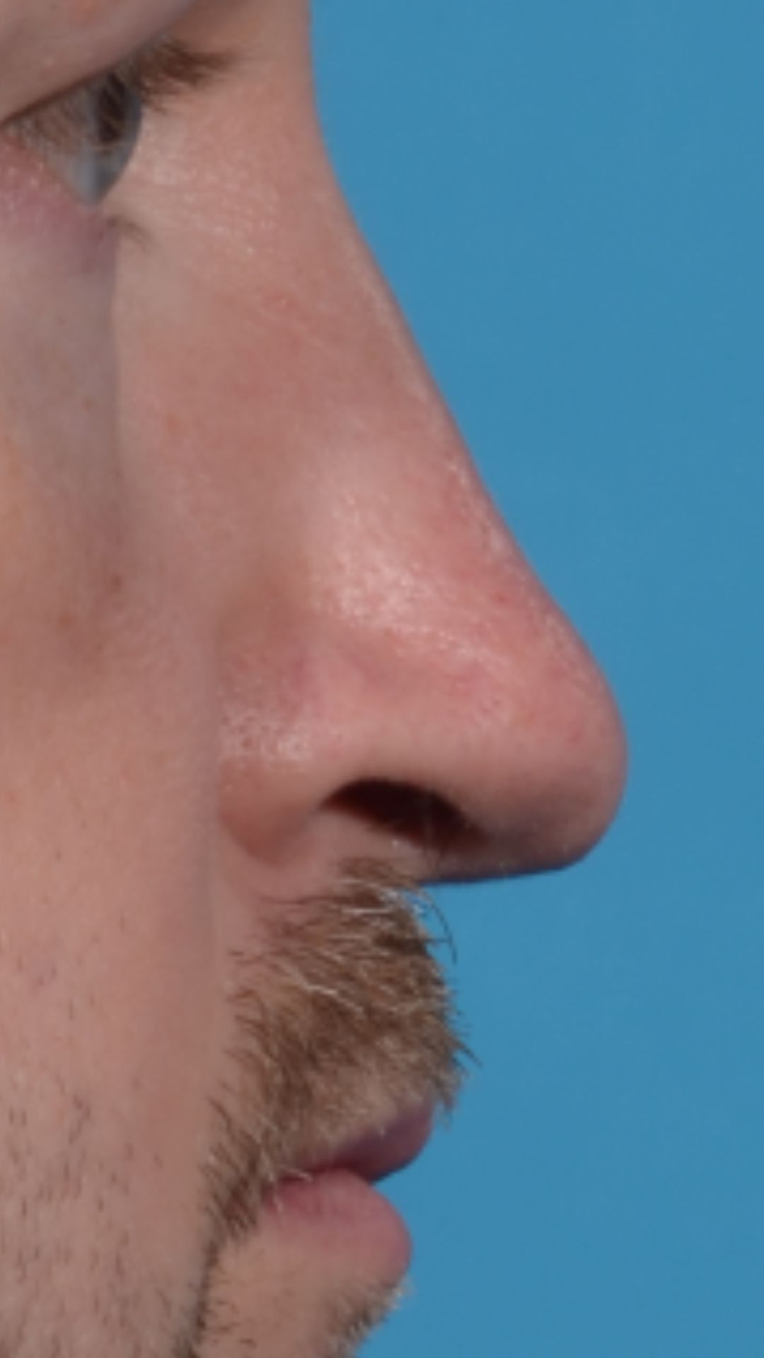Why does my nose look so different from photo to photo? Rhinoplasty