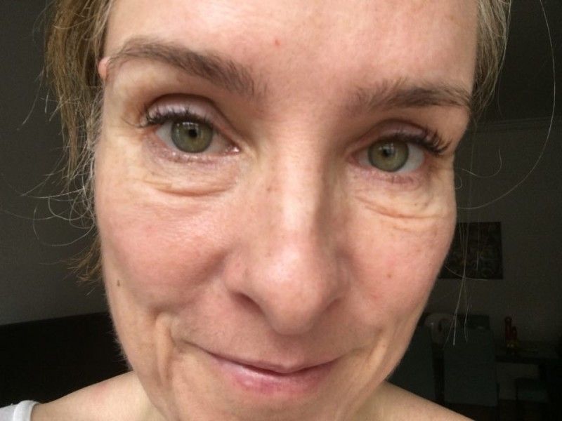 How can I get rid of saggy skin and bags under the eyes? Eyelid