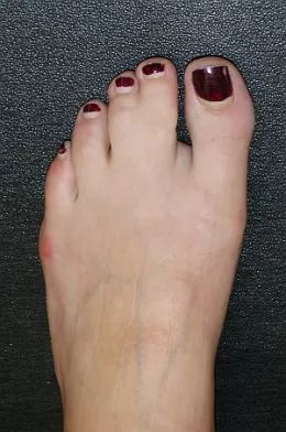 Syndactyly – fused (conjoined) toes | Estheticon.com