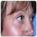 Eyelid surgery (Blepharoplasty) - Photo before - Mr. Christopher Inglefield BSc, MBBS, FRCS(Plast)
