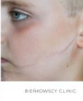 Scar removal - Photo before - Bieńkowscy Clinic®