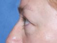 Eyelid surgery (Blepharoplasty) - Photo before - Dr n. med. Lubomir Lembas