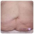 Abdominoplasty (Tummy Tucks) - Photo before - Mr. Christopher Inglefield BSc, MBBS, FRCS(Plast)