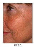 Chemical peeling - Photo before - Martin Molitor, MD, Ph.D., MBA