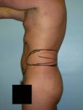 Liposuction - Photo before - Adam J. Rubinstein M.D., FACS