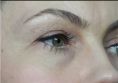 Dermal fillers - Photo before - Dr. med. Stephan Günther