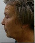Facelift - Photo before - Dr. med. Jozefina Skulavik