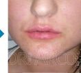 Lip augmentation (fat injection, lipofilling) - Photo before