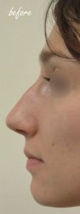 Rhinoplasty (Nose Job) - Photo before - MUDr. Jozef Fedeleš PhD.