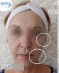 Ultherapy - Photo before - Eveclinic Bratislava