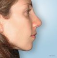 Rhinoplasty (Nose Job) - Photo before - Dr Jose Zayas MD