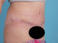 Abdominoplasty (Tummy Tucks) - Photo before - PRIMED Clinic