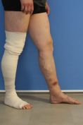 Varicose veins laser treatment - Photo before - MUDr. Jiřina Šilhánková