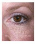 Eyelid surgery (Blepharoplasty) - Photo before