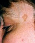 Tattoo removal - Photo before - Asklepion – Laser and Aesthetic medicine