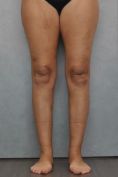 Varicose veins laser treatment - Photo before - MUDr. Jiřina Šilhánková
