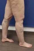 Varicose veins laser treatment - Photo before - MUDr. Jiřina Šilhánková