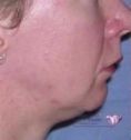 Chin Surgery - Photo before - Mr. Christopher Inglefield BSc, MBBS, FRCS(Plast)