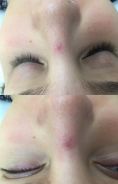 Spider veins laser removal (redness, birh marks) - Photo before - Laserová dermatologická klinika ALTOS