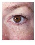 Eyelid surgery (Blepharoplasty) - Photo before - Dr. Albert Feichter