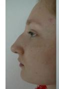 Rhinoplasty (Nose Job) - Photo before - Dr. med. Jozefina Skulavik