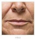 Botulinum toxin - Wrinkle Removal - Photo before - Martin Molitor, MD, Ph.D., MBA