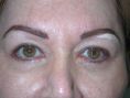 Eyelid surgery (Blepharoplasty) - Photo before - Adam J. Rubinstein M.D., FACS