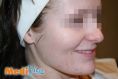 Laser acne treatment - Photo before - lek. med. Jacek Ściborowicz - MediVita