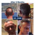 Hair Transplant - Photo before - Dr. Emrah Cinik