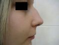 Rhinoplasty (Nose Job) - Photo before - MUDr. Libor Polák