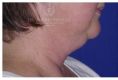Chin Liposuction - Photo before - Dr. Albert Feichter