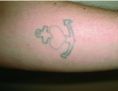 Tattoo removal - Photo before - Asklepion – Laser and Aesthetic medicine