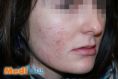 Laser acne treatment - Photo before - lek. med. Jacek Ściborowicz - MediVita