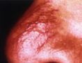 Spider veins laser removal (redness, birh marks) - Photo before - Asklepion – Laser and Aesthetic medicine