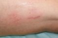Spider veins laser removal (redness, birh marks) - Photo before - lek. med. Jacek Ściborowicz - MediVita