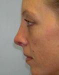 Rhinoplasty (Nose Job) - Photo before - Adam J. Rubinstein M.D., FACS