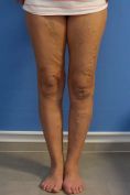 Varicose veins laser treatment - Photo before - MUDr. Jiřina Šilhánková