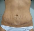 Abdominoplasty (Tummy Tucks) - Photo before - Dr. med. Jozefina Skulavik