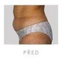 Liposuction - Photo before - Martin Molitor, MD, Ph.D., MBA