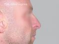 Rhinoplasty (Nose Job) - Photo before - Asklepion – Laser and Aesthetic medicine