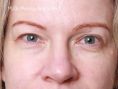 Eyelid surgery (Blepharoplasty) - Photo before - Asklepion – Laser and Aesthetic medicine