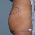 Buttock and calf plastic surgery - Photo before - Mr. Christopher Inglefield BSc, MBBS, FRCS(Plast)