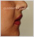 Cleopatra Clinic, Klinika Plastické Chirurgie s.r.o. - Photo before - Cleopatra Clinic, Klinika Plastické Chirurgie s.r.o.