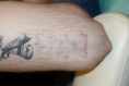 Tattoo removal - Photo before - lek. med. Jacek Ściborowicz - MediVita