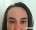 Botulinum toxin - Wrinkle Removal - Photo before - Concept Clinic