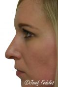 Rhinoplasty (Nose Job) - Photo before - MUDr. Jozef Fedeleš PhD.
