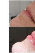 Lip augmentation - cheiloplasty - Photo before - Concept Clinic