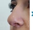 Non-Surgical Nose Job - Photo before
